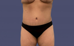 Abdominoplasty (Tummy Tuck) 17 After